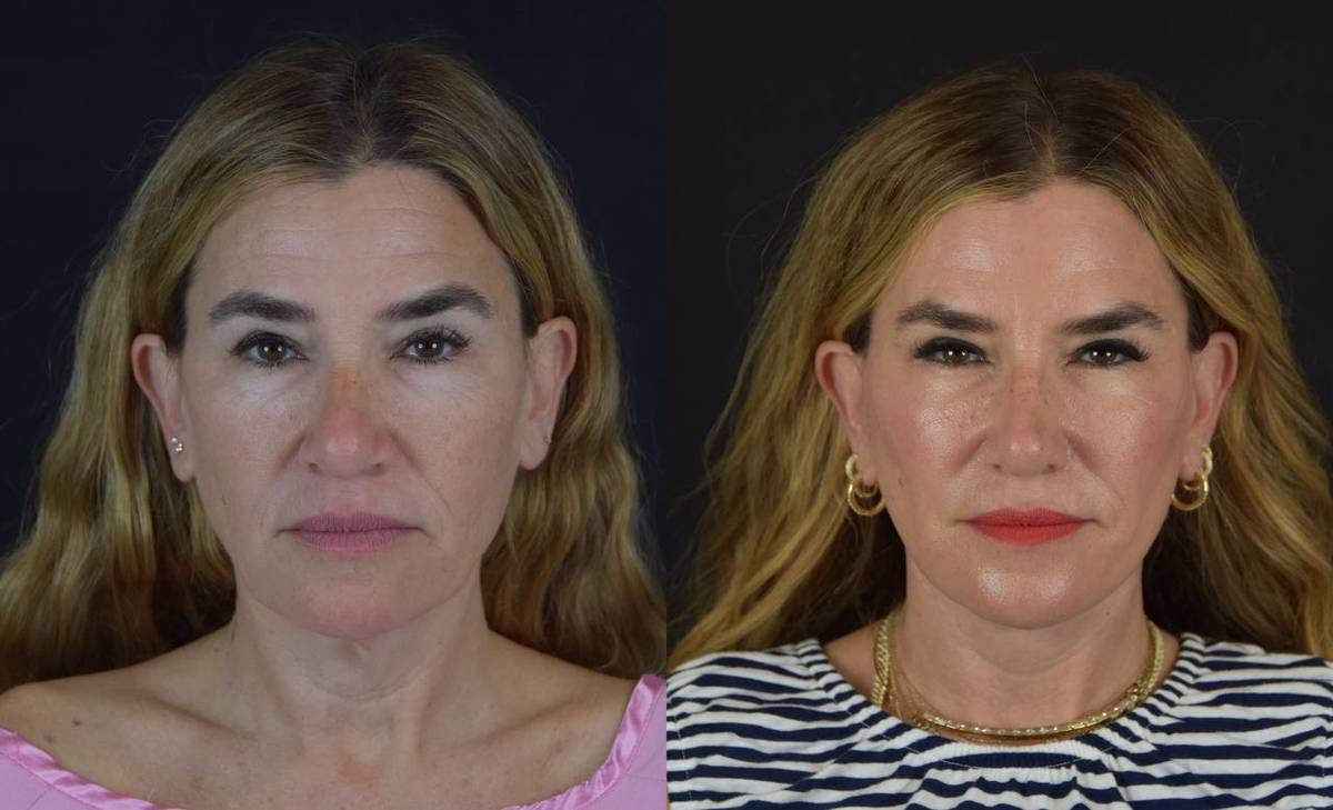 alli webb facelift