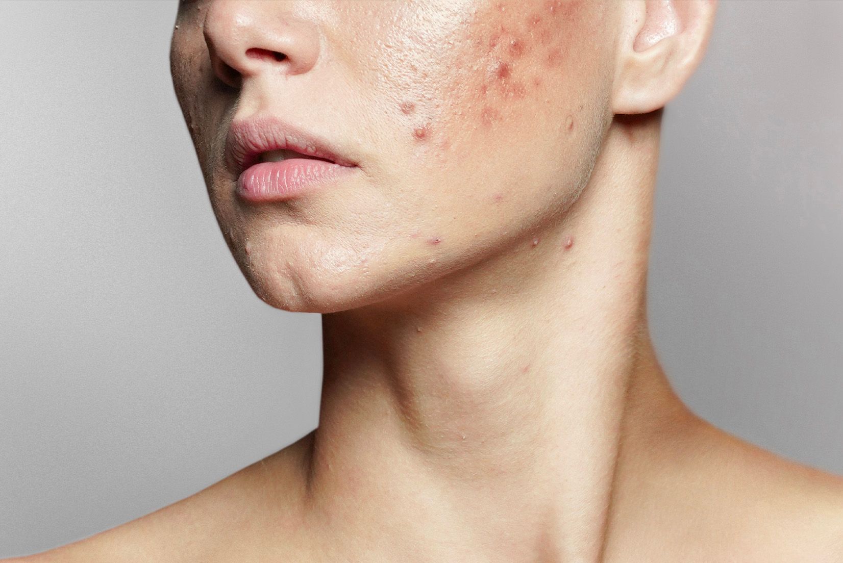 Dermatologists Share the Best Acne Advancements of the Last 5 Years