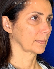 Dr. Dilip D. Madnani - Facelift - Before