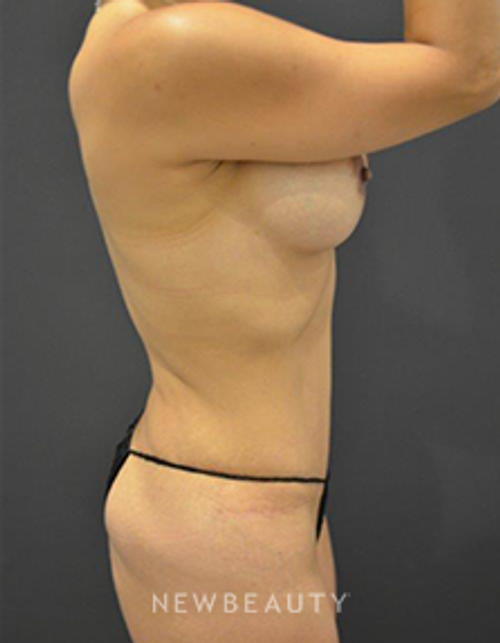 Dr. B. Aviva Preminger - Mommy Makeover - After