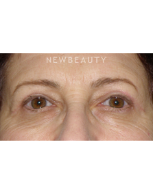Dr. George Sanders - Eyelift - After