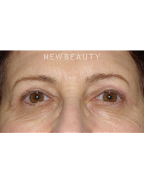 Dr. George Sanders - Eyelift - After