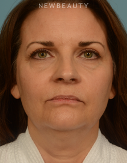 Dr. Bryan Gawley - Facelift - Before