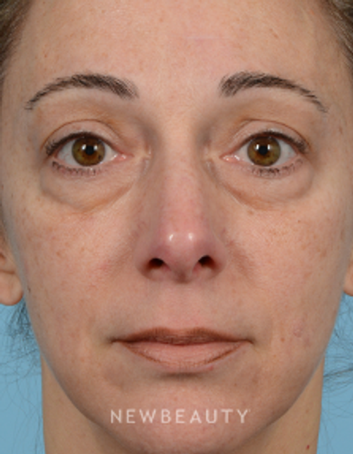 Dr. Jeffrey B. Wise - Lower Blepharoplasty - Before