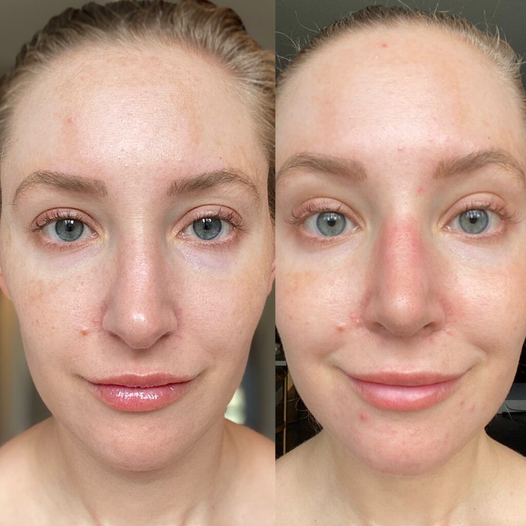 Jillian Gottlieb nose job surgery before-and-after image