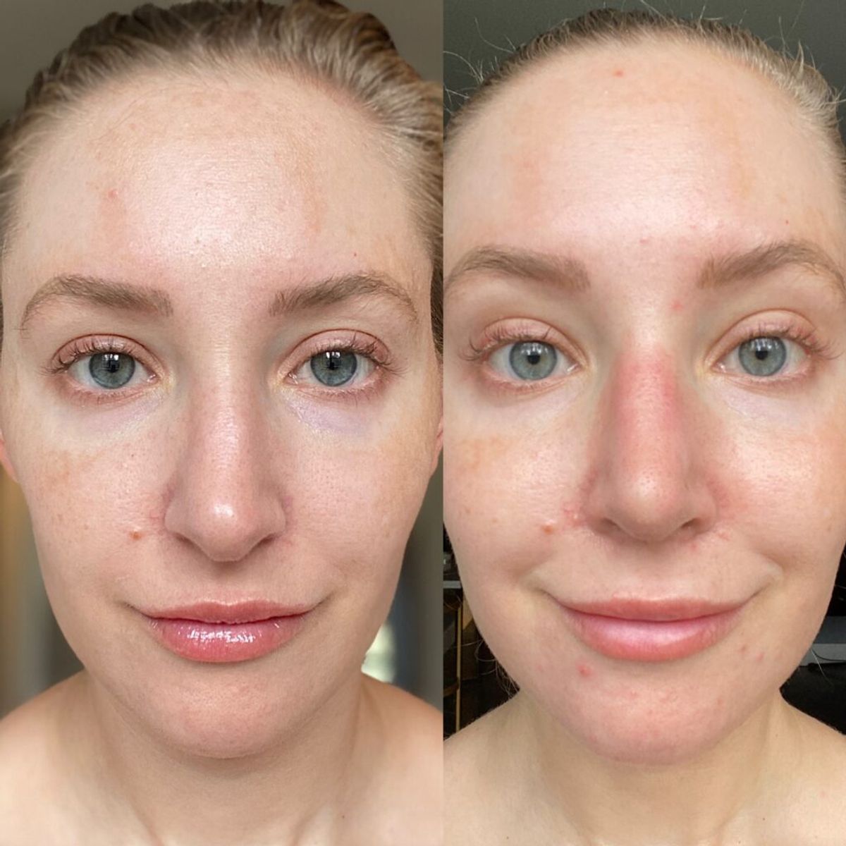 Jillian Gottlieb nose job surgery before-and-after image