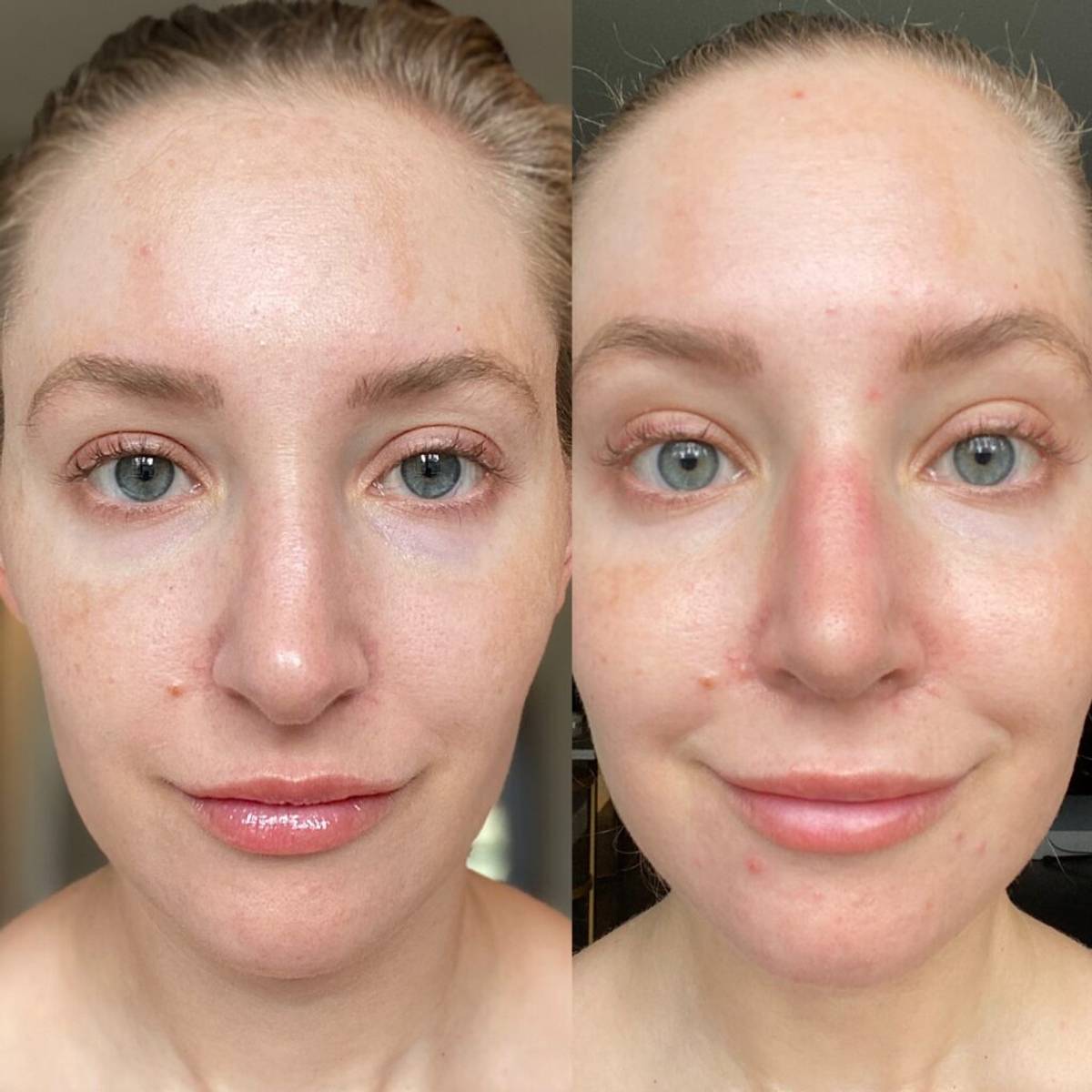 Jillian Gottlieb nose job surgery before-and-after image