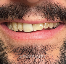 Dr. Lana Rozenberg - Smile Makeover - 47194480 - Before