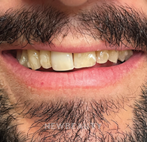 Dr. Lana Rozenberg - Smile Makeover - 47194480 - Before