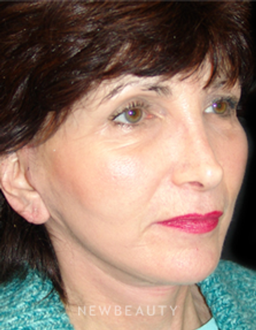 Dr. Mokhtar Asaadi Eyelid Lift, Facelift, Necklift - After