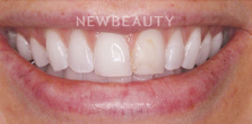 Dr. Victoria Veytsman - Smile Makeover - Before