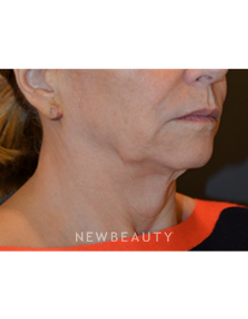 Dr. B. Aviva Preminger - Facelift and Necklift - Before
