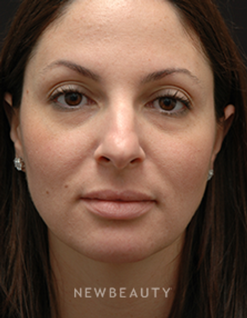 Dr. Jeffrey B. Wise - Rhinoplasty - Before