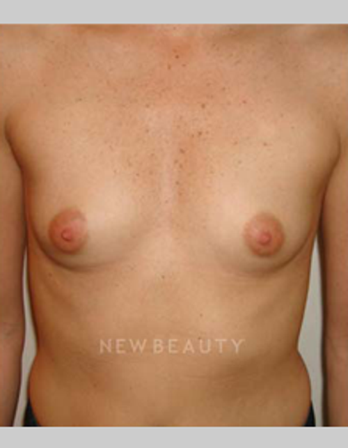 Dr. Michael Horn Silicone Breast Implants - Before