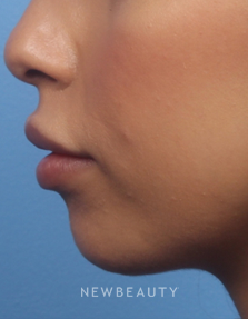 Dr. Kelly Bomer - Chin Augmentation - Before