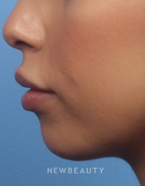 Dr. Kelly Bomer - Chin Augmentation - Before