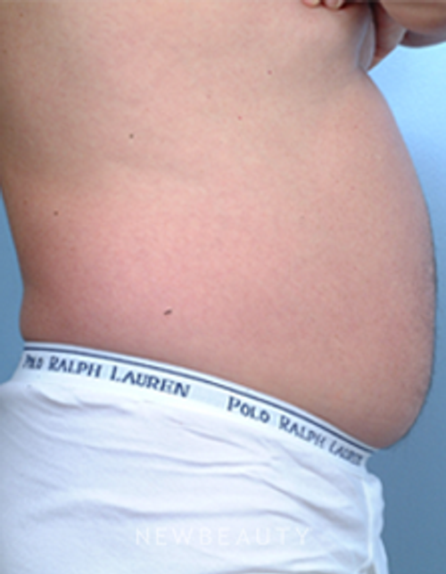 Dr. Steven Bloch, Liposuction - Before