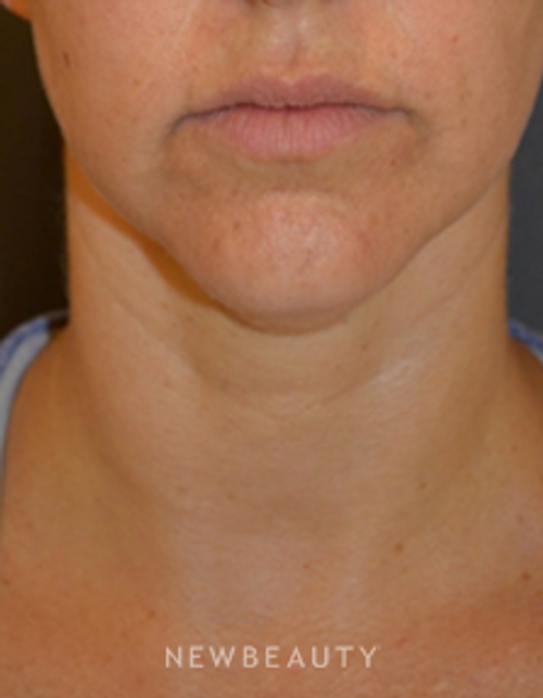 Dr. Aviva Preminger - Kybella - After