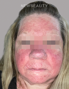 Dr. Anna Chacon - Rosacea - 34278072 - After