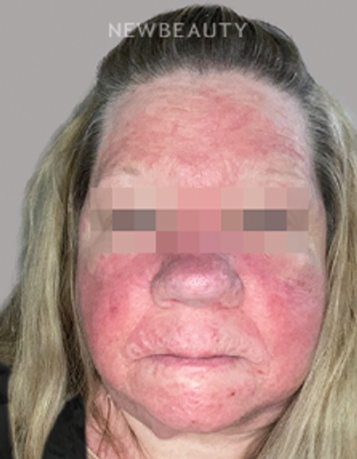 Dr. Anna Chacon - Rosacea - 34278072 - After