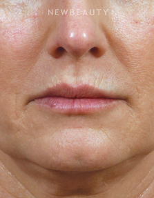 Dr. Kenneth Beer - Lip Filler - After