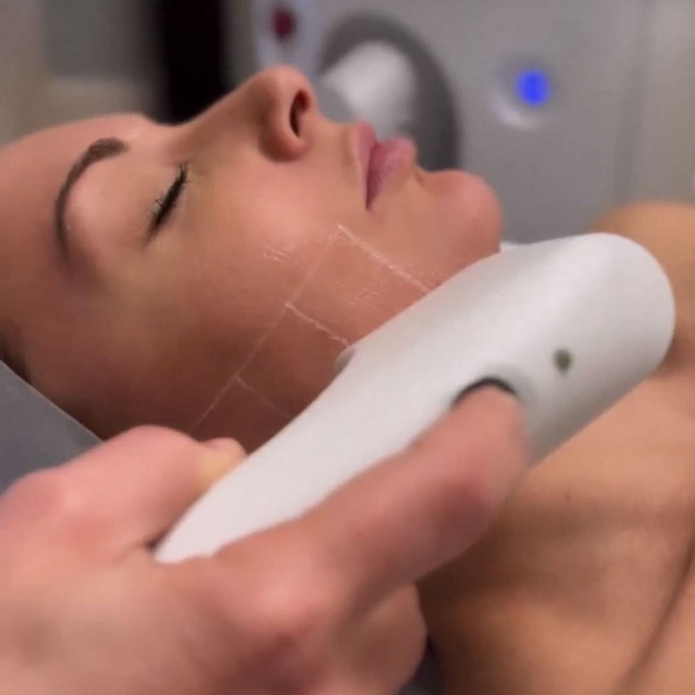 sofwave face treatement