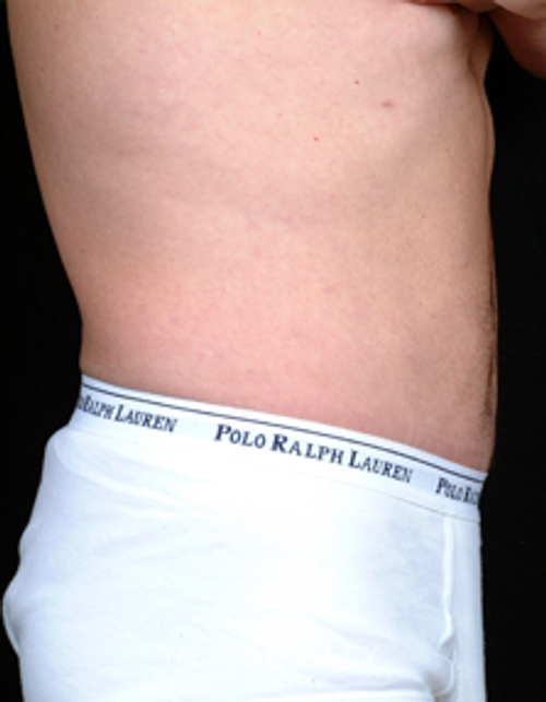 Dr. Steven Bloch, Liposuction - After