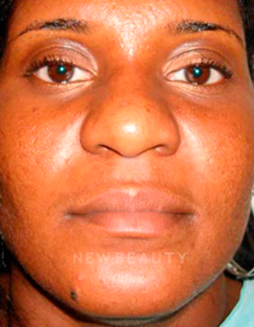 Dr. David Kim Rhinoplasty - Before