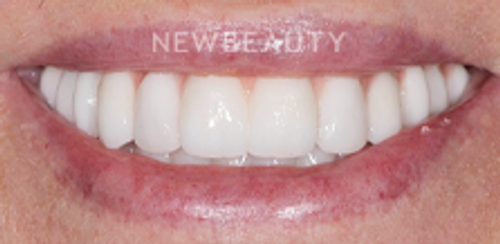 Dr. Salvator La Mastra - Smile Makeover -46106922 - After