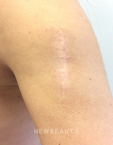 Dr. Julie Russak - Laser Resurfacing - After