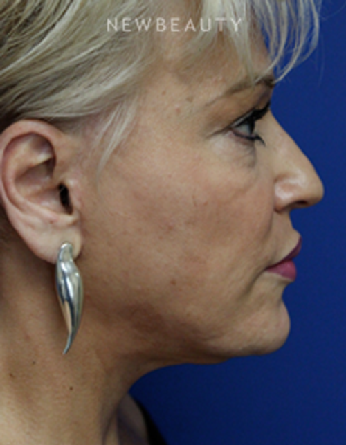 Dr. Joseph Russo - Full-Face Rejuvenation (Face EBG) - After