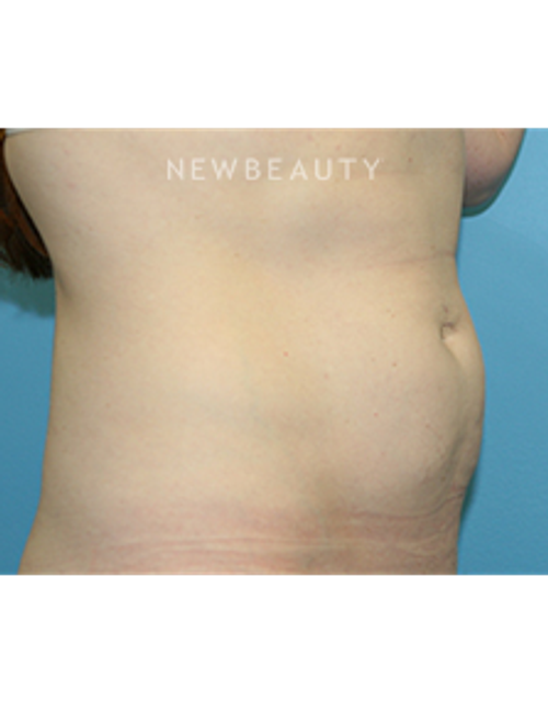 Dr. Christine Hamori - Liposuction - Before
