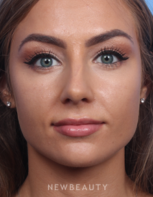 Dr. James Bouzoukis - Nonsurgical Rhinoplasty - After