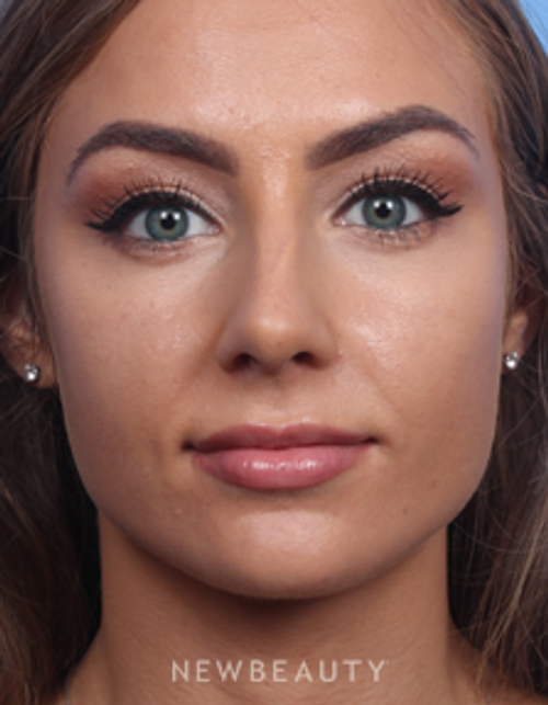 Dr. James Bouzoukis - Nonsurgical Rhinoplasty - After