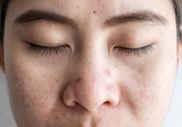 Close-up of a person with closed eyes and acne-prone skin and post-acne marks on the nose and cheeks