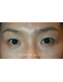 Dr. John Kang - Blepharoplasties & Rhinoplasty - Before