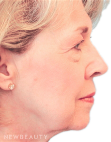 Dr. Henry Mentz Facelift - Before