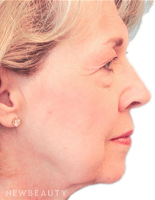 Dr. Henry Mentz Facelift - Before
