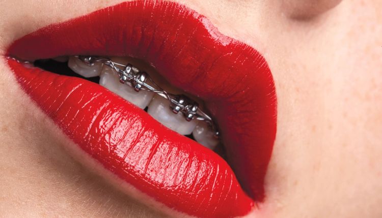 Get It Straight: 6 Options for Adult Teeth Straightening