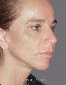 Dr. Konstantin Vasyukevich Facelift, Necklift - After