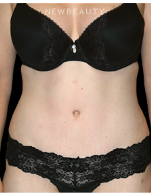 Dr. Bryan W. Gawley - A New Waistline - After