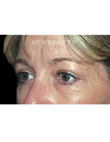 Dr. Roman Rayham - Natural-Looking Results - After