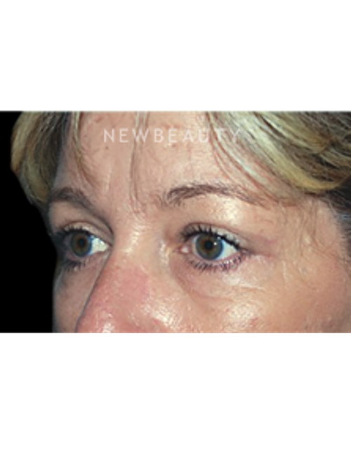 Dr. Roman Rayham - Natural-Looking Results - After