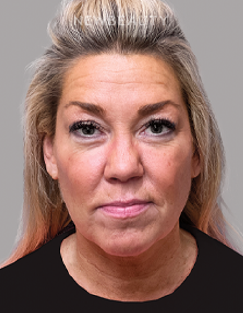 Dr. Michael A. Epstein - Elegant Facial Rejuvenation - 33109024 - Before