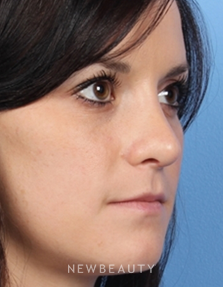 Dr. Kelly Bomer – Rhinoplasty - After