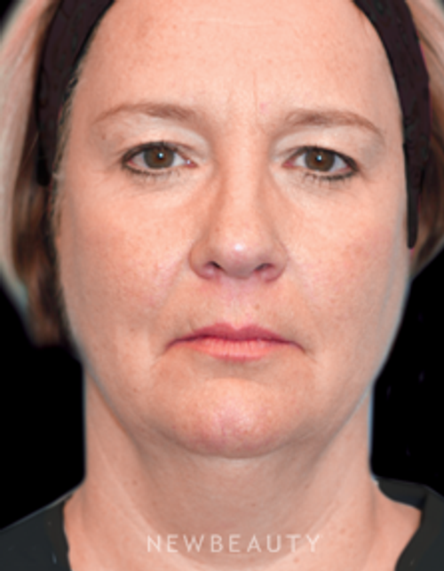 Dr. Christine Hamori - Necklift - Before
