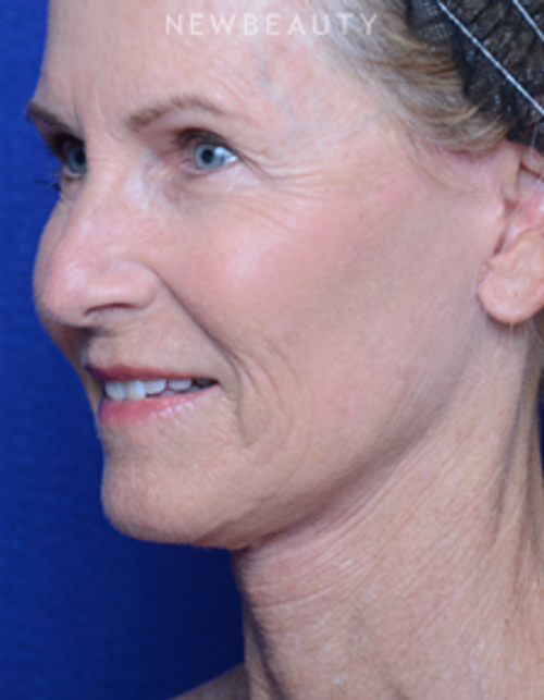 Dr. Alan Durkin - Facelift - After