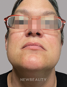 Dr. Anna Chacon – Skin Treatment - 34277072 - After