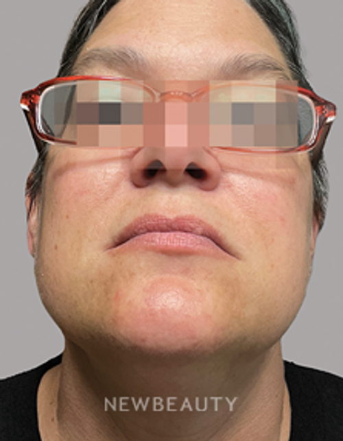 Dr. Anna Chacon – Skin Treatment - 34277072 - After