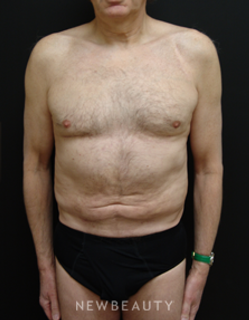 Dr. Mokhtar Asaadi Liposuction - After